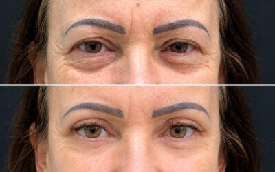 Cirurgia da Pálpebra: benefícios que vão além da estética